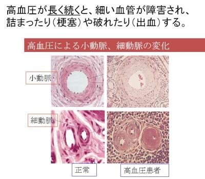 高血圧により詰まった血管画像